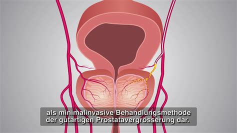 Vergrösserte Prostata ohne Operation behandeln Prostata Embolisation