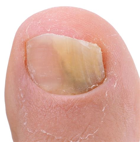 Top 139 How To Treat Nail Discoloration Architectures Eric