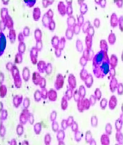 Peripheral Blood Smear Shows Agranulocytosis Download Scientific Diagram