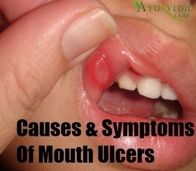 Most single mouth ulcers are caused by damage to the lining inside of the mouth. Common Causes And Symptoms Of Mouth Ulcers | Herbal ...