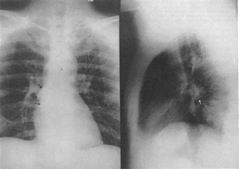 Diagnostic Carbon Dioxide Pneumomediastinography As An Extension Of