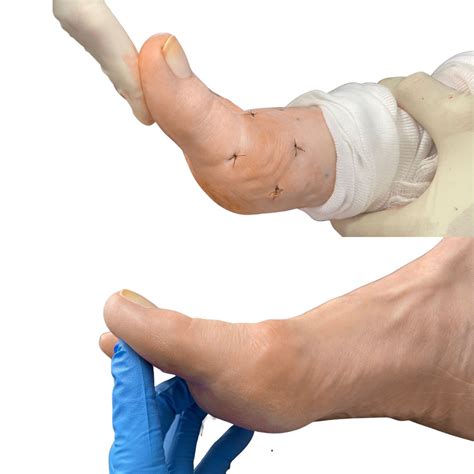 Hallux Limitus Rigidus Cda Foot And Ankle