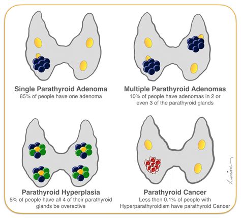 Thyroid Adenoma Histology