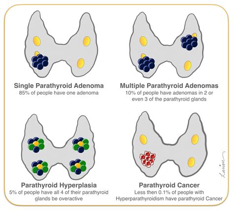 Parathyroid Gland Hyperplasia