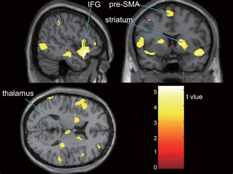 Brain Regions With Significantly Lower Activation In The Conduct