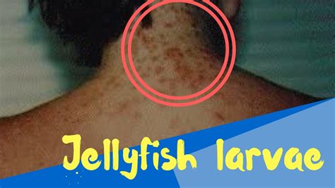 look this an outbreak of ‘sea lice is taking over beaches with devastating results youtube