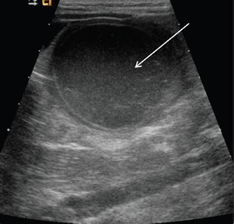 Hemorrhagic Ovarian Cyst Longitudinal View Of The Pelv Open I
