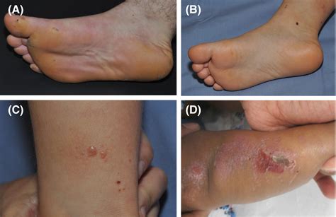 Inherited Epidermolysis Bullosa New Diagnostics And New Clinical