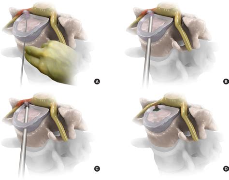 PDF Anterior Endoscopic Cervical Discectomy Surgical Technique And Literature Review