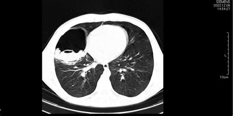 Chest Ct Scan Showing A Large Cavitary Lesion On The Middle Lobe Of The