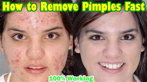 How To Remove Pimples Fast Overnight Remove Pimples Naturally At