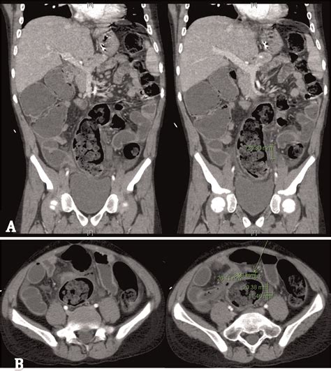 Imaging In Patients With Chronic Granulomatous Disease