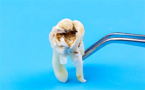 Broken Wisdom Tooth How It Is Caused And What To Do