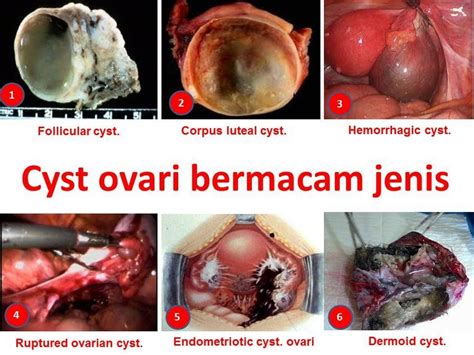 Apakah yang dimaksudkan dengan ovarian cyst? ~VitaminShop2u~: Pemakanan Selepas Pembedahan Cyst dan Fibroid