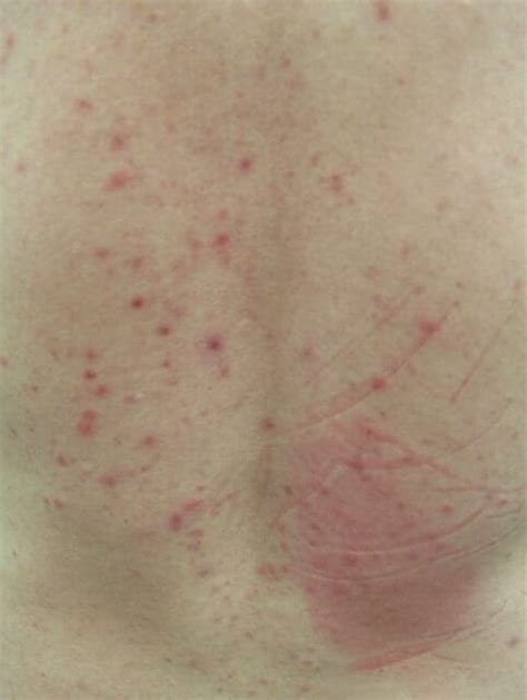 Pityrosporum Folliculitis Itchy Rash On Back Dermatology Advisor