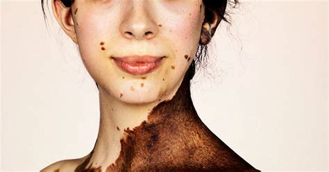People With Rare Skin Condition Challenge Perceptions Of Beauty In