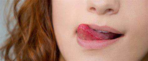 Wir haben aktuell besuch mit lippenherpes. Ist Zungenbrennen ansteckend?