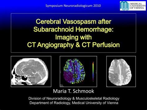 Cerebral Vasospasm After Subarachnoid Hemorrhage Imaging With