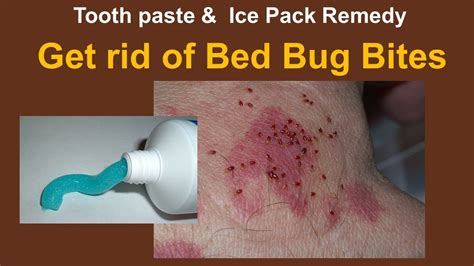 How To Get Rid Of Bed Bug Bites On Your Skin Naturally Tooth Paste