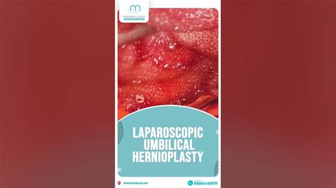 Laparoscopic Umbilical Hernioplasty Marinas Clinic Youtube