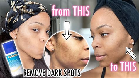 How To Get Rid Of Dark Spots On Your Face And Get Clear Skin I Used