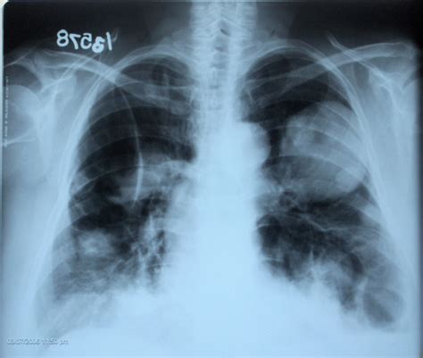 Chest Radiography Shows Multiple Nodules And Masses Involving Both