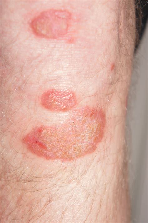 Dry Spots On Leg