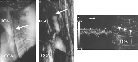 Figure 2 From Transoral Carotid Ultrasonography As A Diagnostic Aid In