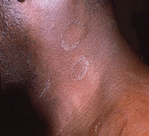 Not All Round Rashes Are Ringworm A Differential Diagnosis Of