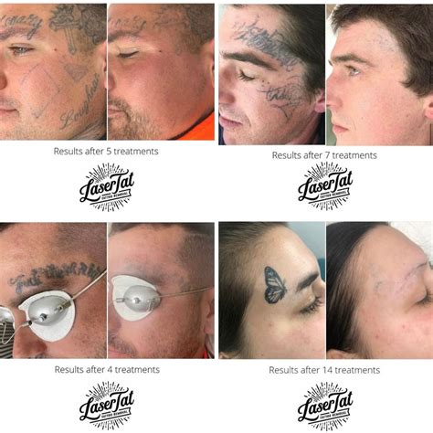 Update 73 Tattoo Laser Removal Before And After Ineteachers