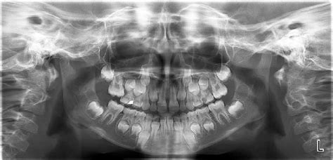 Orthopantogram Showing Ectopic Eruption Of Maxillary Right First