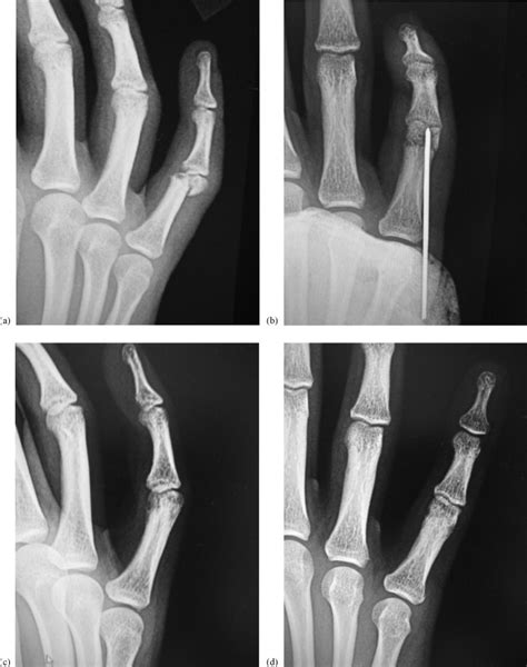 Phalangeal Neck Fractures Of The Proximal Phalanx Of The Fingers In