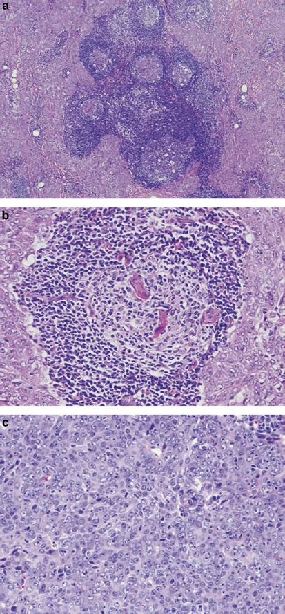 Lymphoid Follicles With Prominent Germinal Centers Are A Characteristic