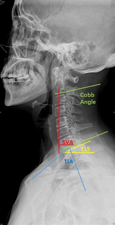 The Sagittal Balance Of The Cervical Spine Was Evaluated By The C2 C7