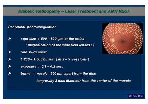 Ovali Diabetic Retinopathy Laser Treatment Anti Vegf