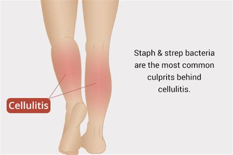 Cellulitis Causes When To Worry What To Do Emedihealth Hot Sex Picture