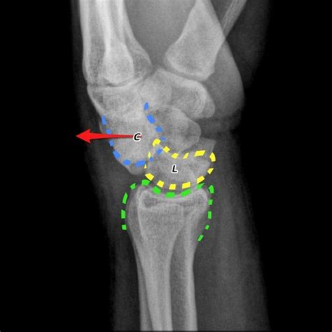 Perilunate Dislocation And Scaphoid Fracture Kulturaupice