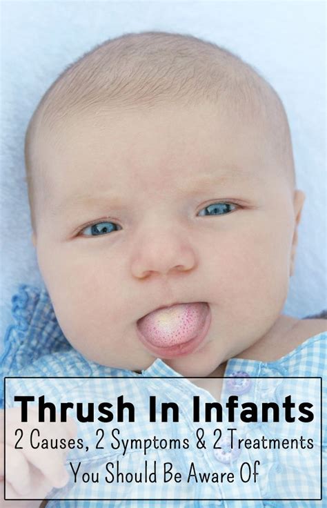 Pros And Cons Of White Coating On The Babys Tongue Baby Tongue Baby