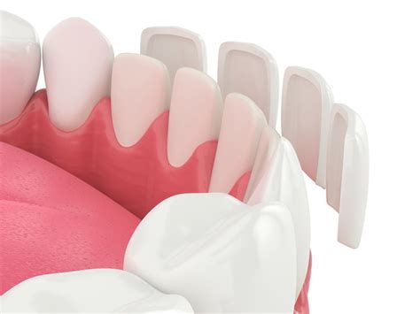 are porcelain dental veneers a good option for you complete dental