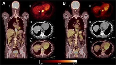 18f Fdg Pet And 18f Fdg Petct For Assessing Response To Therapy In