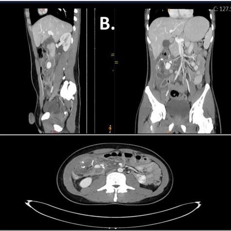 Abdominal Ct Scan Showing Signs Of Terminal Ileitis And Typhlitis With