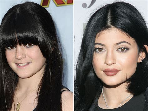 kylie jenner s lips and nose job before and after surgery celebily celebrity