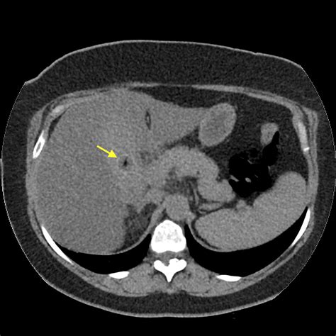 Acute Cholecystitis And Ureteric Colic Image