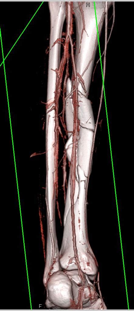 Open Tibial Fracture In 3d With Vascular Injury Musculoskeletal Case