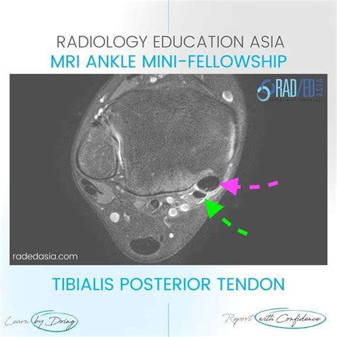 Tibialis Posterior Tendinitis Tendinopathy Tears Radiology Mri