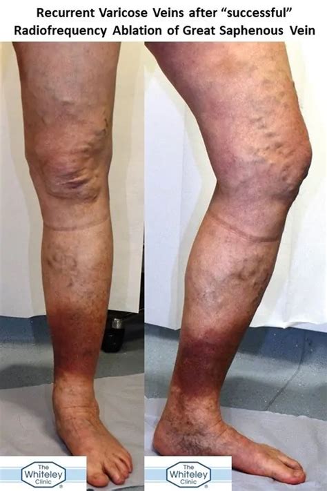 Recurrent Varicose Veins After Successful Rfa The Whiteley Clinic