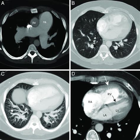 Pulmonary Veno Occlusive Disease Pvod In A 34 Year Old Woman A