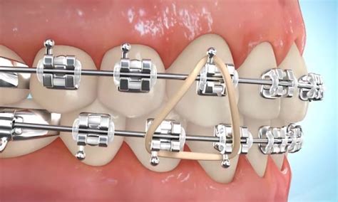 If you have actually used braces enough how to treat pain caused by the rubber bands in braces? How to Put Rubber Bands On Braces | Premier Orthodontics