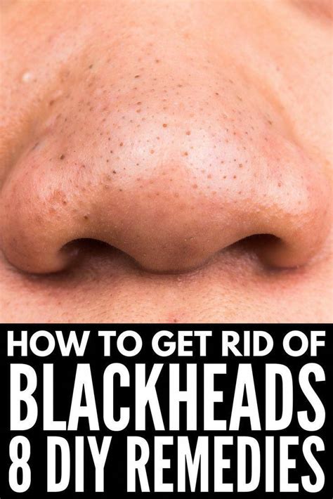 How To Get Rid Of Blackheads Looking For The Best Way To Remove