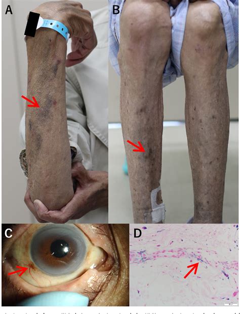 Figure 1 From Minocycline Induced Hyperpigmentation Importance Of